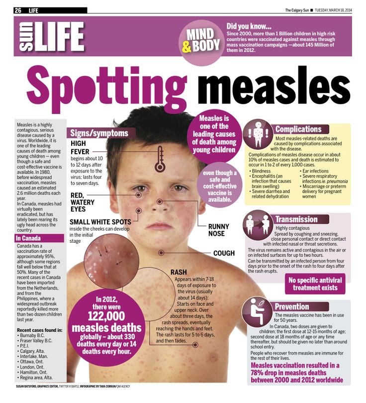 Treatment for measles in babies