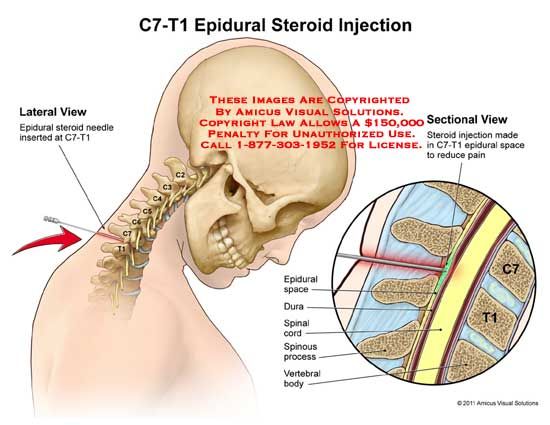 What is in an epidural injection for labor