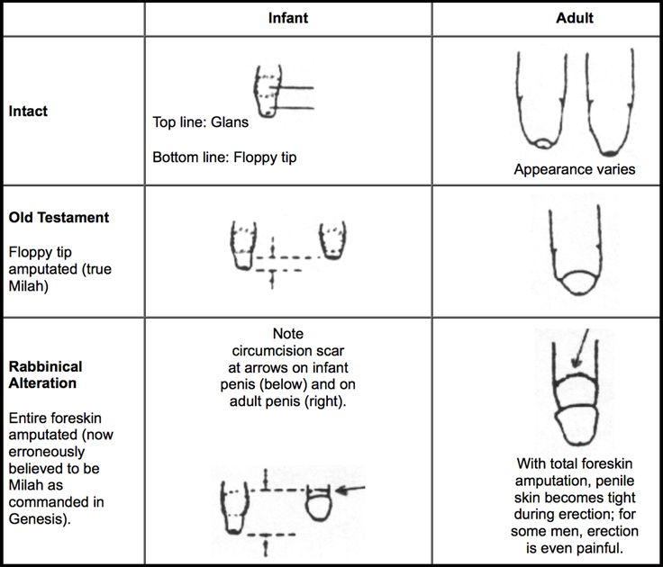 How do you circumcise a newborn