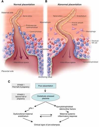 What are early signs of preeclampsia