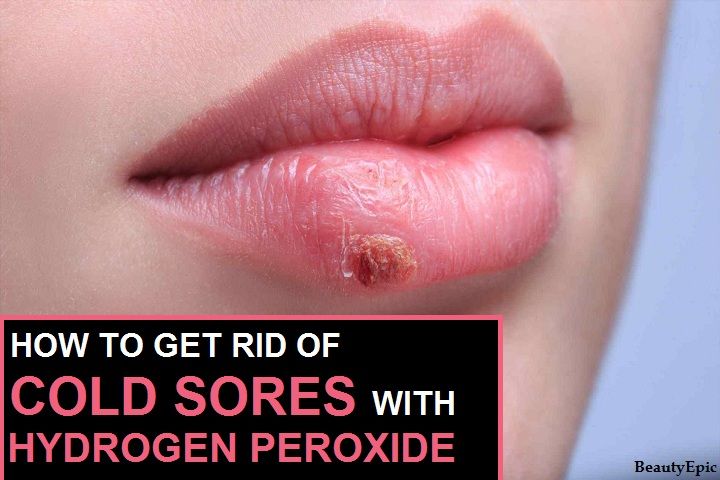Cold sore on lip during pregnancy