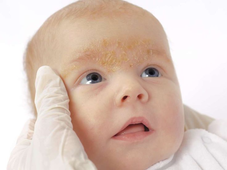 Rashes on babies to worry about