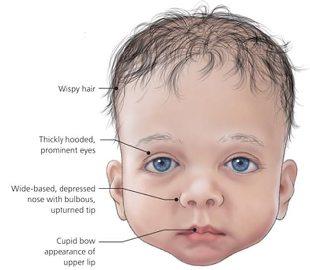 Cleft lip is an example of a congenital disorder