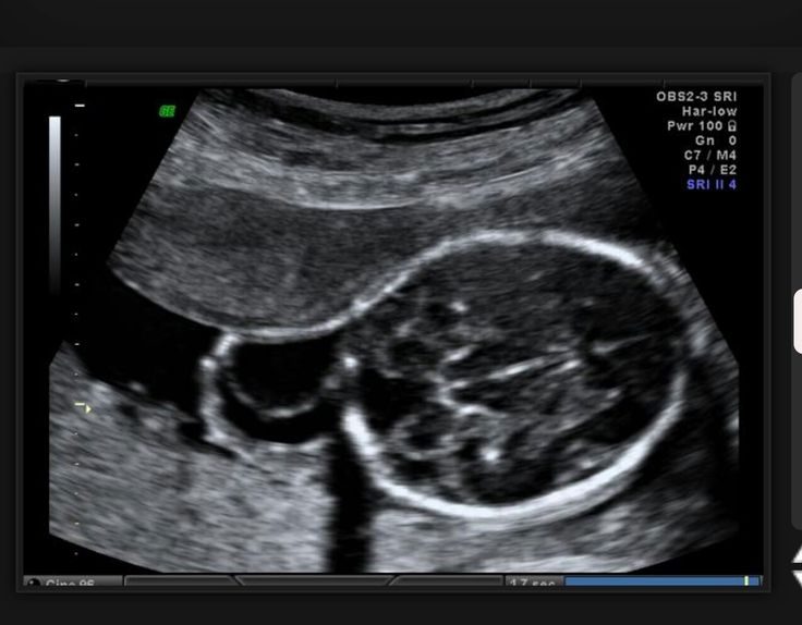 Down syndrome fetal ultrasound