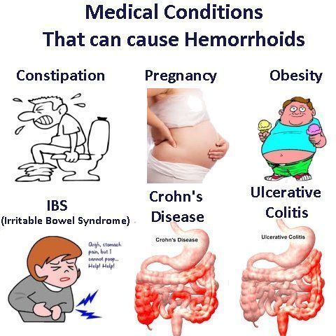 Hemorrhoids cream during pregnancy