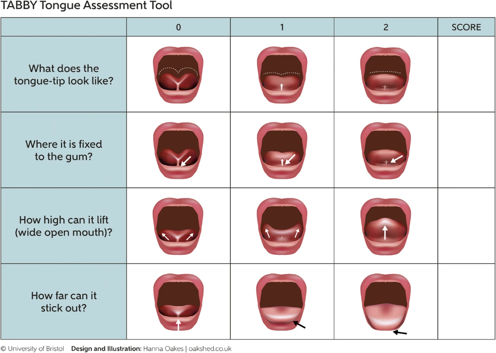 How to tell if child has tongue tie