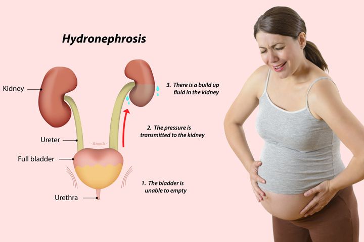 Symptoms of a uti while pregnant