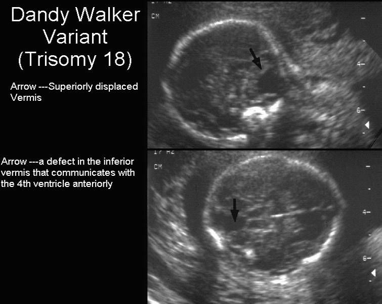 What is the most common neural tube defect