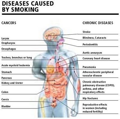 What causes blindness at birth