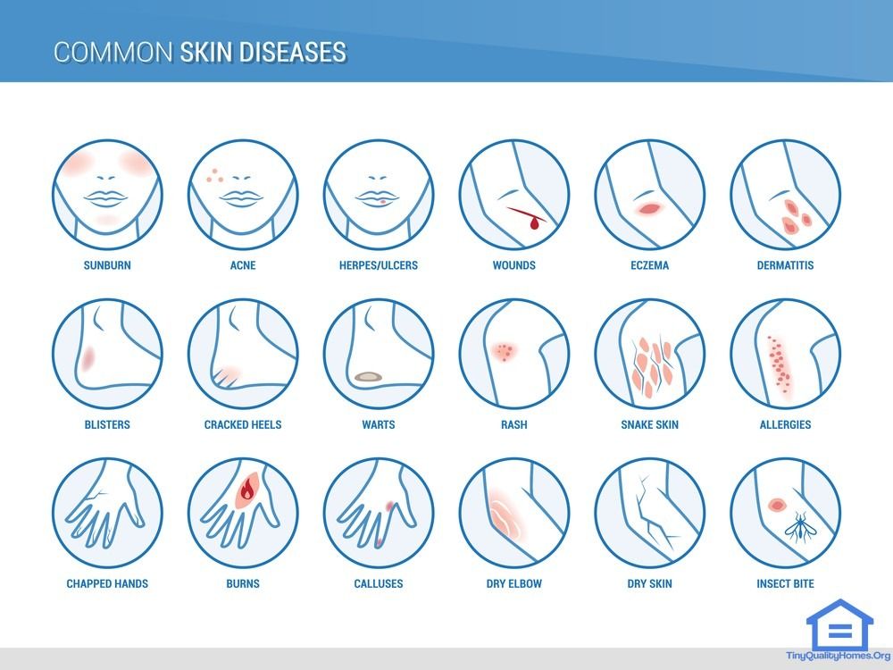 Infant skin rash types