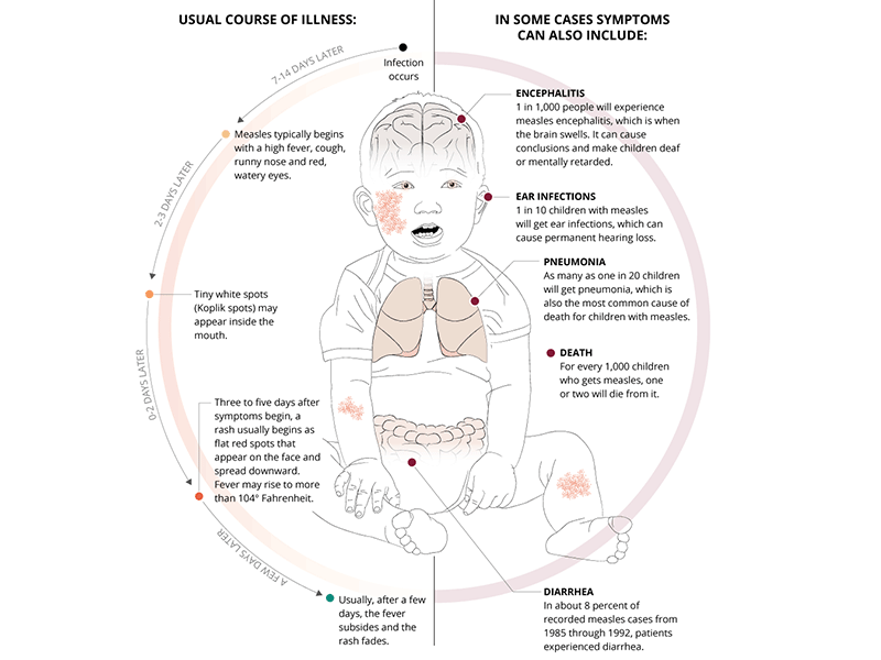 How to treat a child with measles