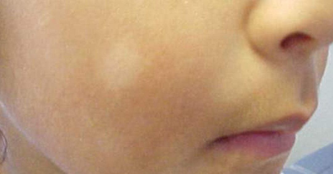 Rash on face white bumps