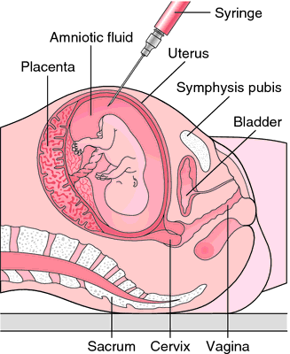 Miscarriage amniotic fluid