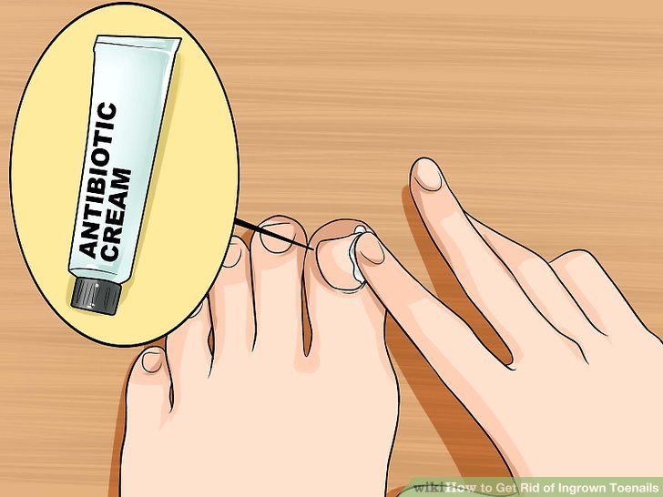 How to get rid of an ingrown toenail in a child