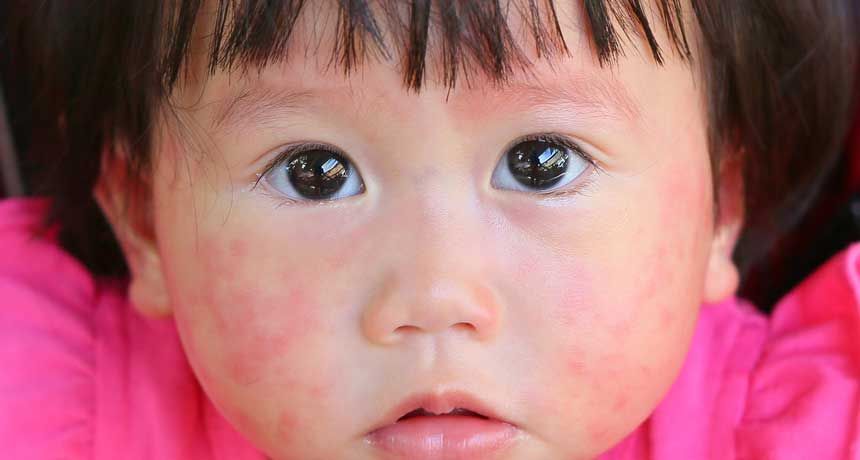 Red face rash newborn