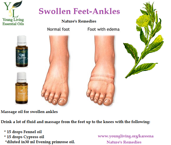 Remedy for swelling during pregnancy