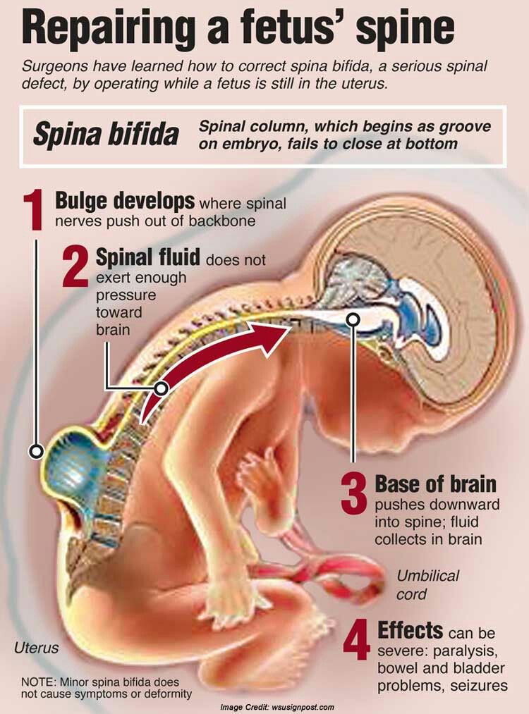 Anencephaly and spina bifida