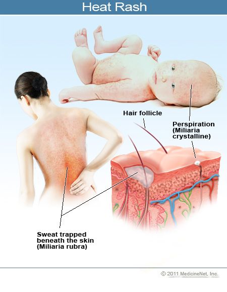 Infant rashes on back