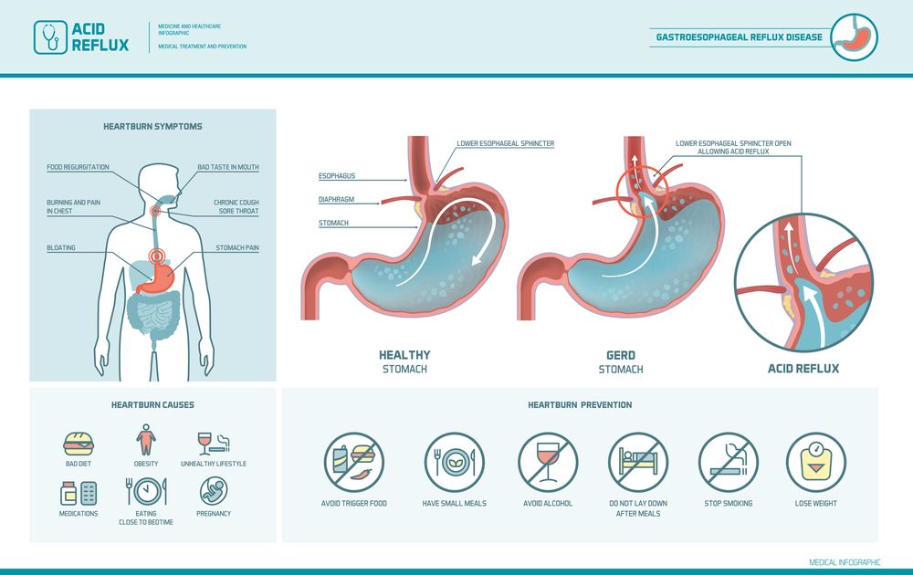 Acid reflux sign of early pregnancy