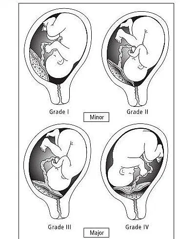 Placenta grade 1 means