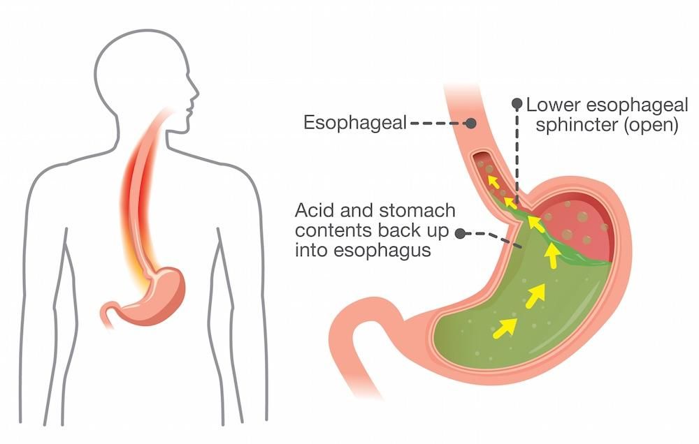 Heartburn pregnant what can i take