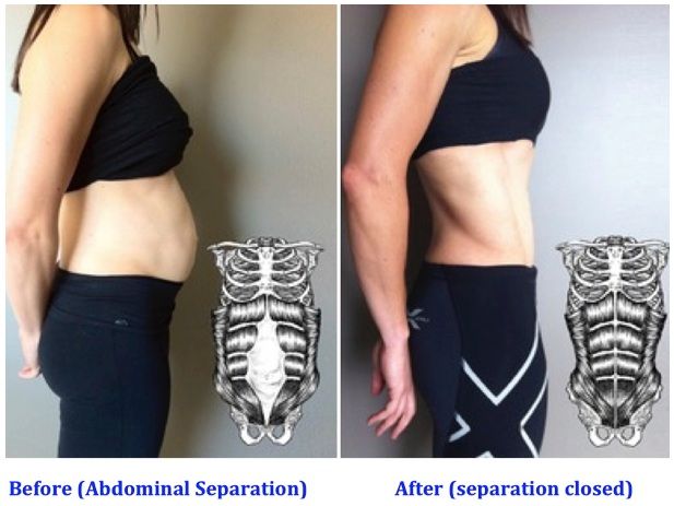 Abdominal muscle separation post pregnancy