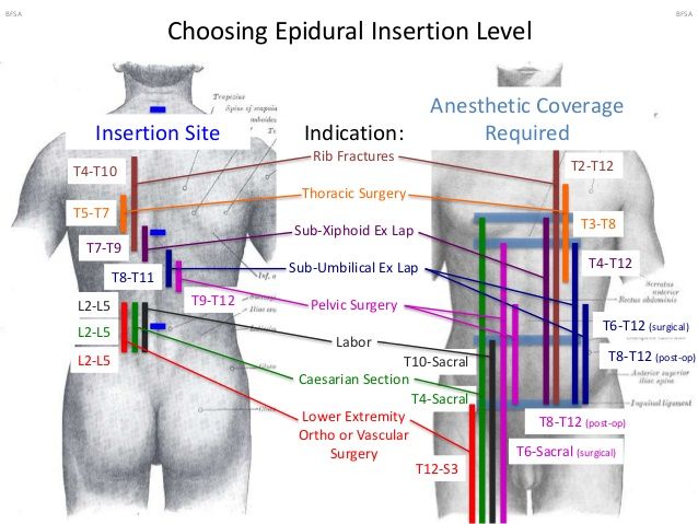 Does an epidural stay in your back