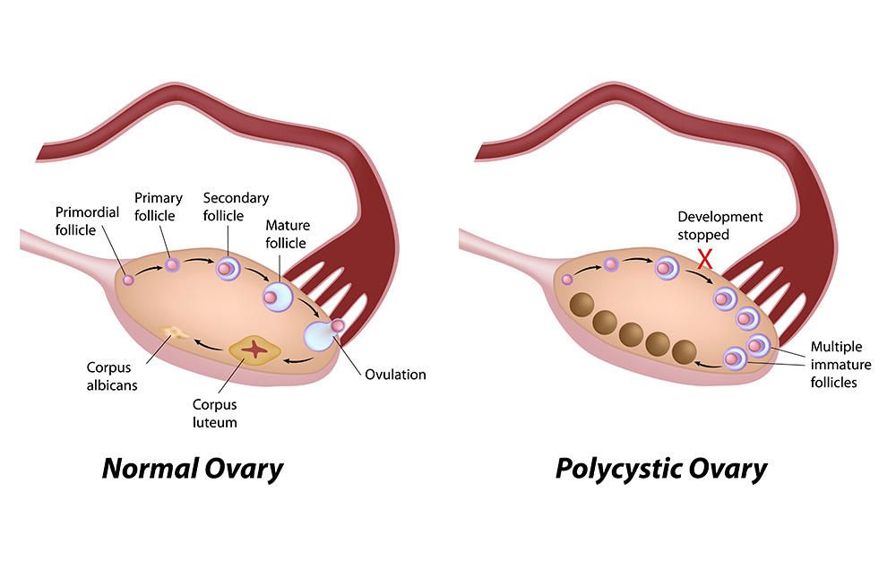 Polycystic ovarian syndrome pregnancy complications