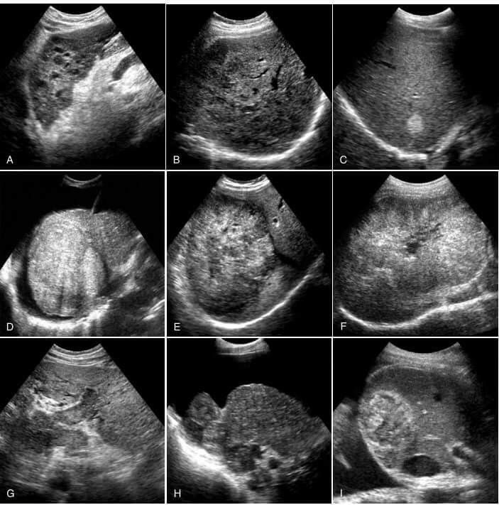 Ultrasound through vagina