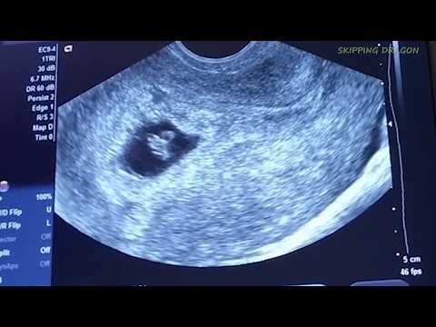 Removal of fetus after miscarriage