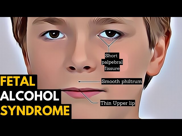 Signs of down syndrome while pregnant