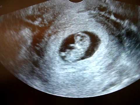 10 weeks transabdominal ultrasound