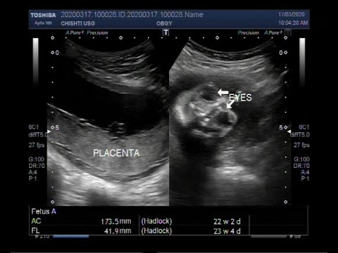 When can you see spina bifida in ultrasound