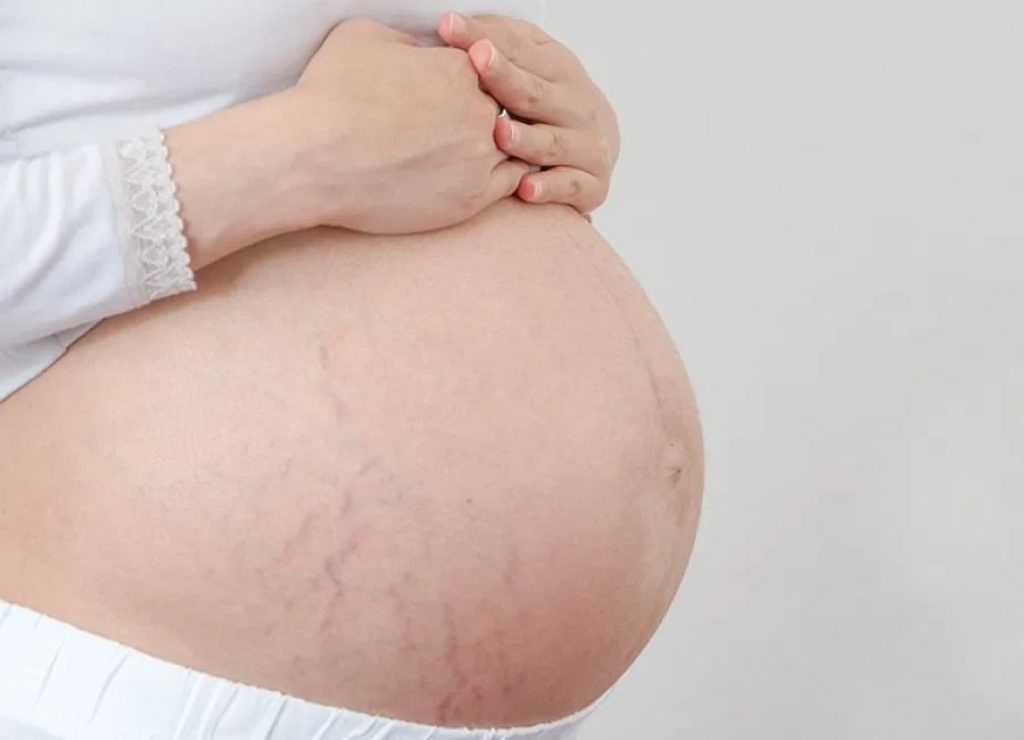 Stretch marks on pregnant women