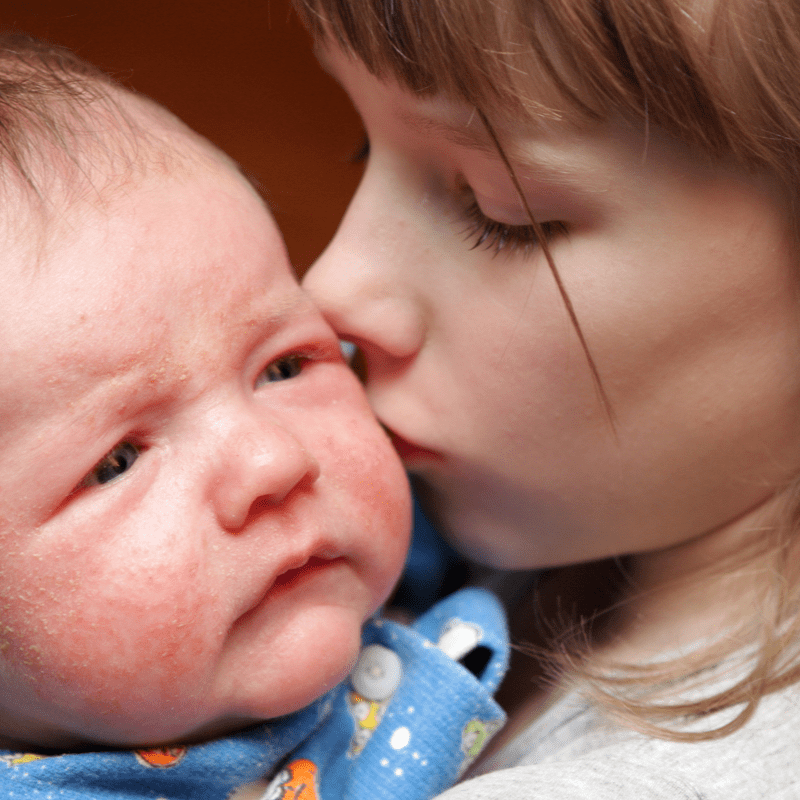 Allergic reaction baby milk allergy rash pictures