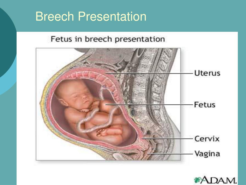 Breech birth delivery