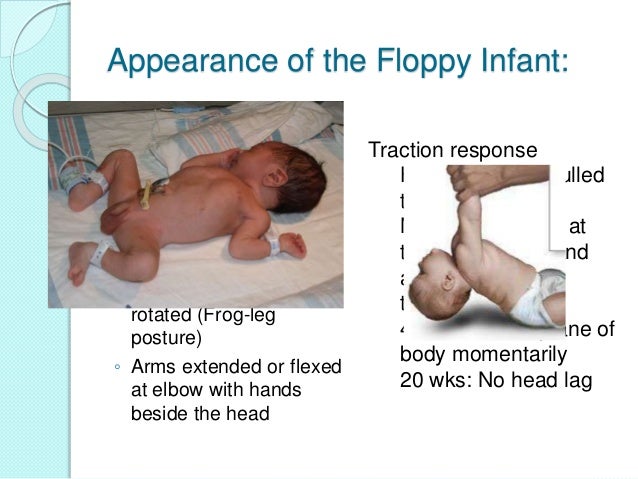 What do seizures look like in infants