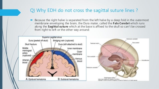 Does an epidural stay in your back