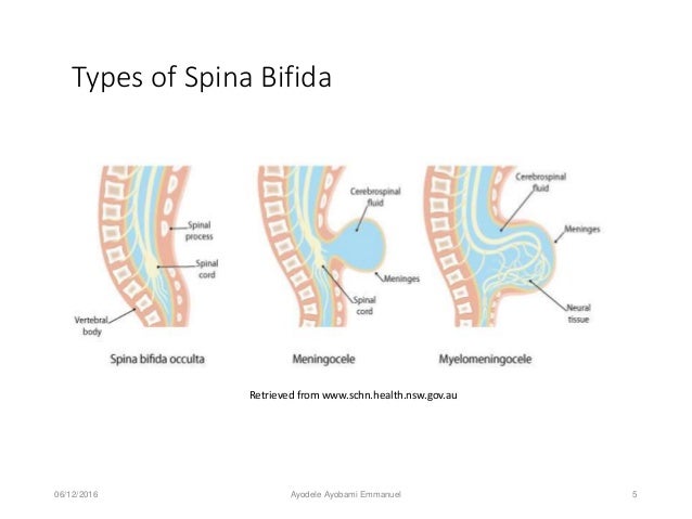 Preventing spina bifida