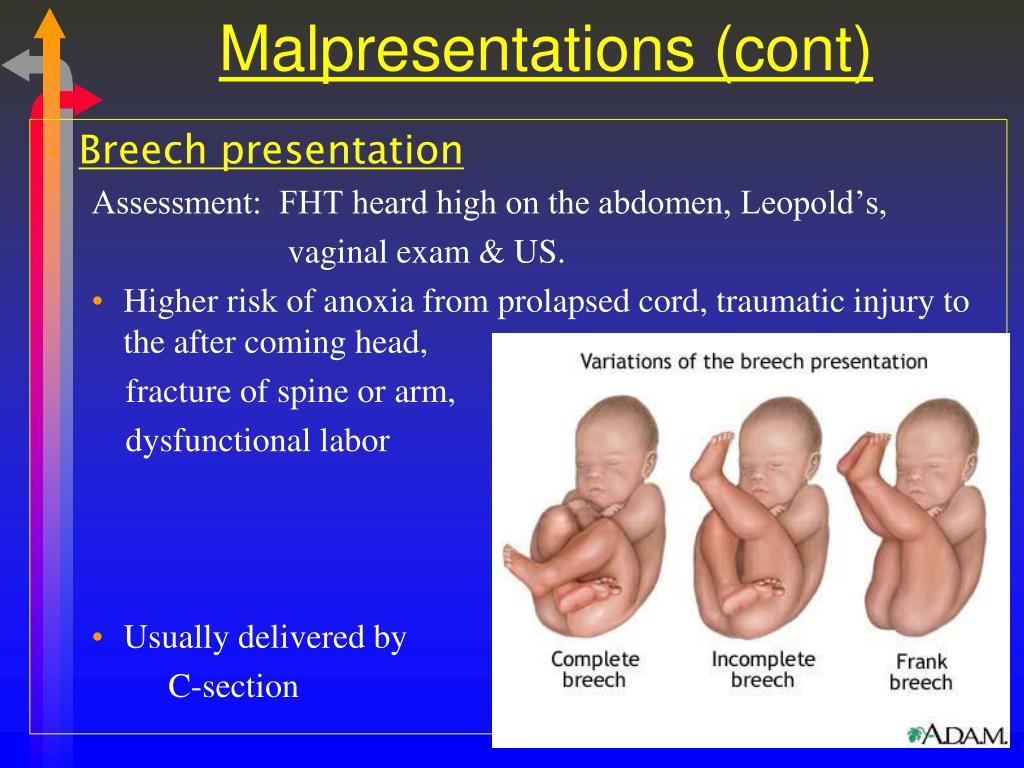 Breech position definition