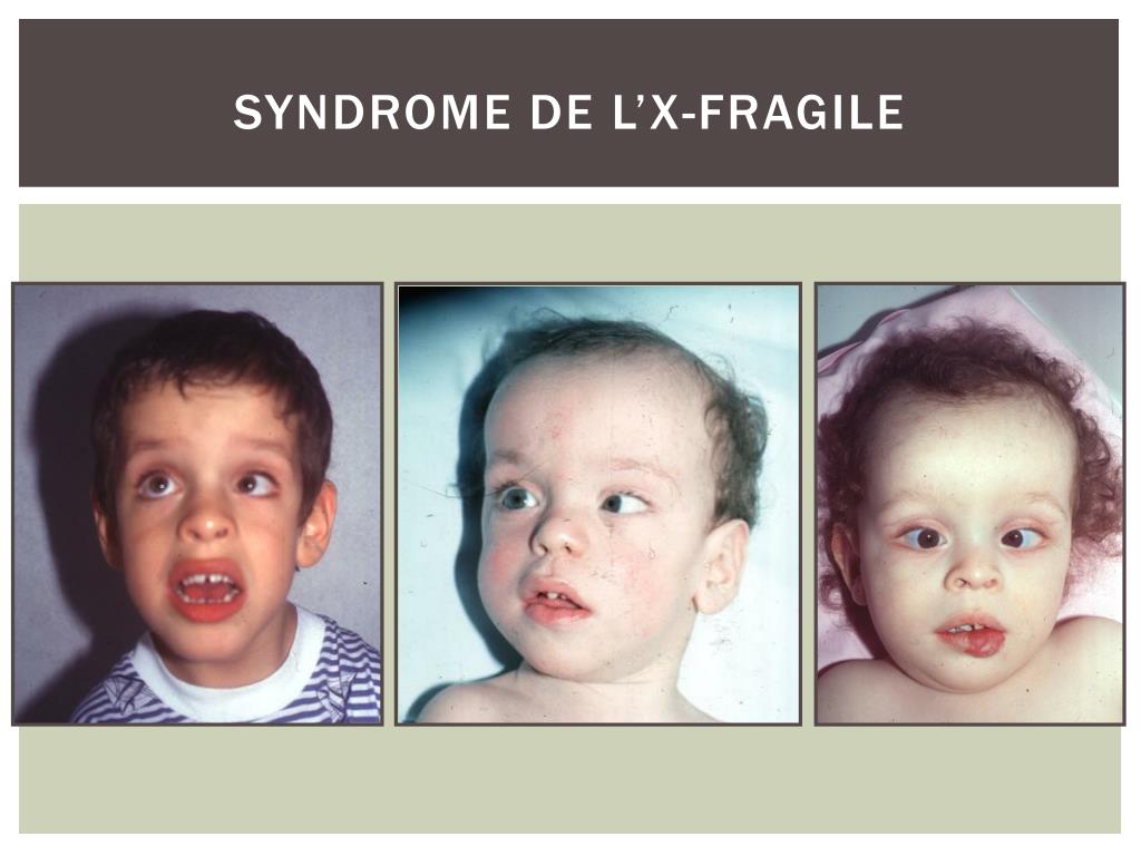 Baby fragile x syndrome