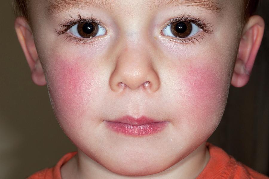 Small rashes on face of baby