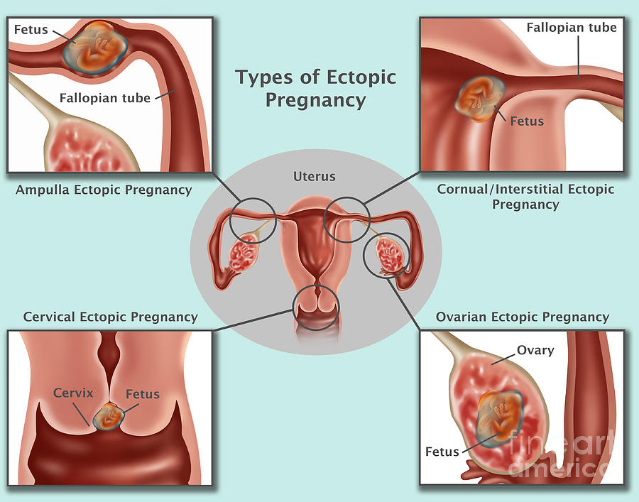Ectopic pregnancy occurs when