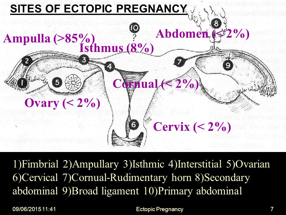 Ectopic pregnancy time frame