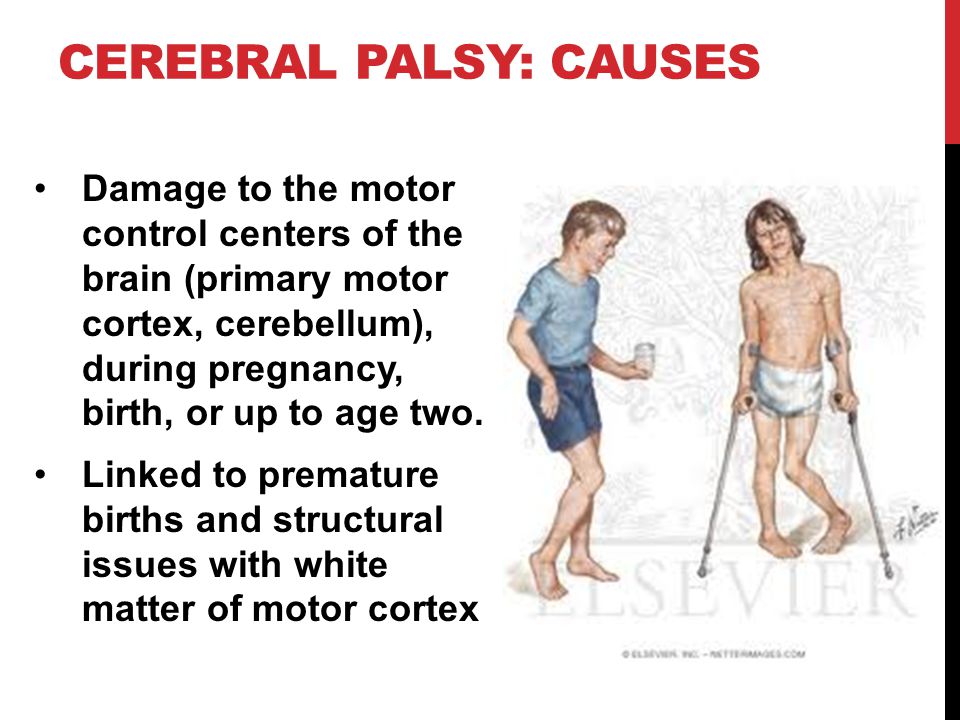 Cerebral palsy from birth