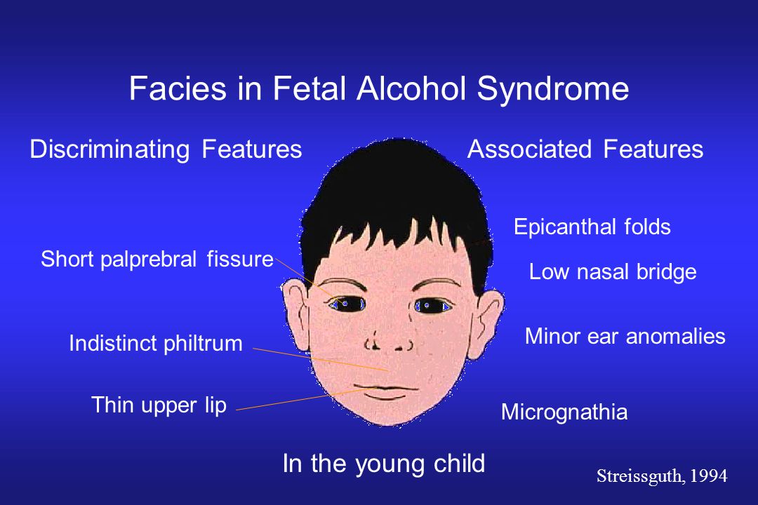 How does fetal alcohol syndrome affect a child