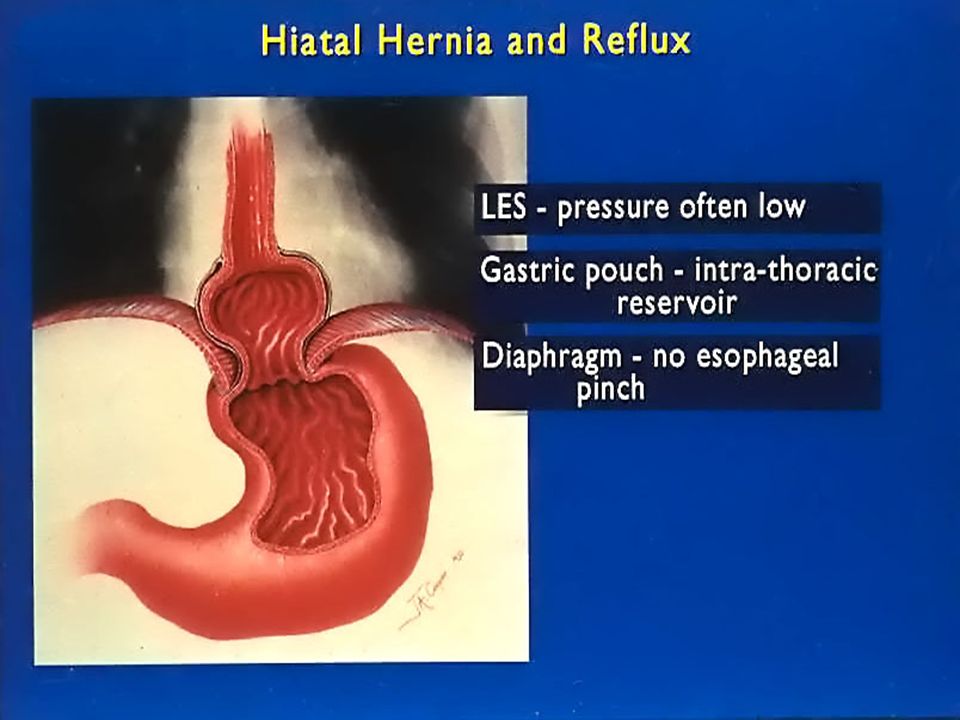 Acid reflux nausea pregnancy