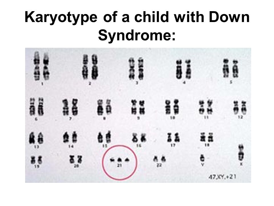 Chromosome 21 test