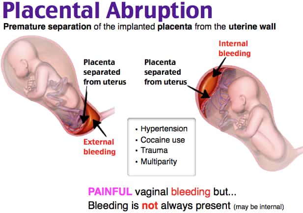 Placenta accreta discovered after delivery