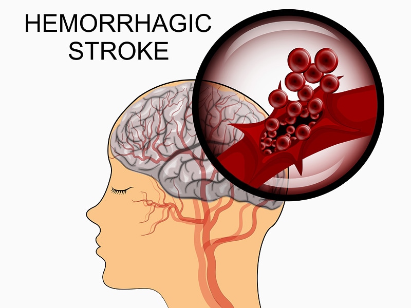 Blood pressure and nose bleeding